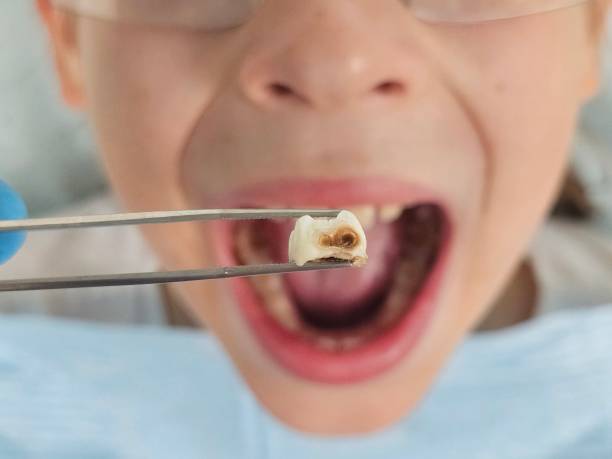 Best Emergency Care for Gum Disease in Bostonia, CA